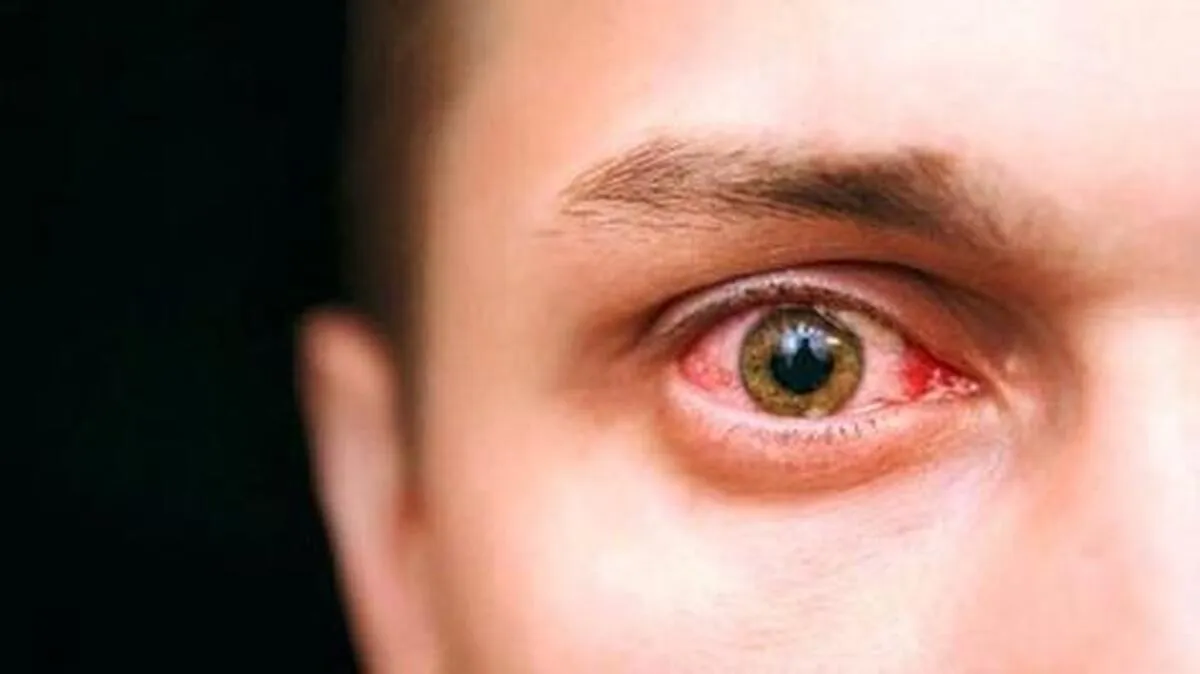 جزییات شیوع کرونای چشمی در ایران+ عکس