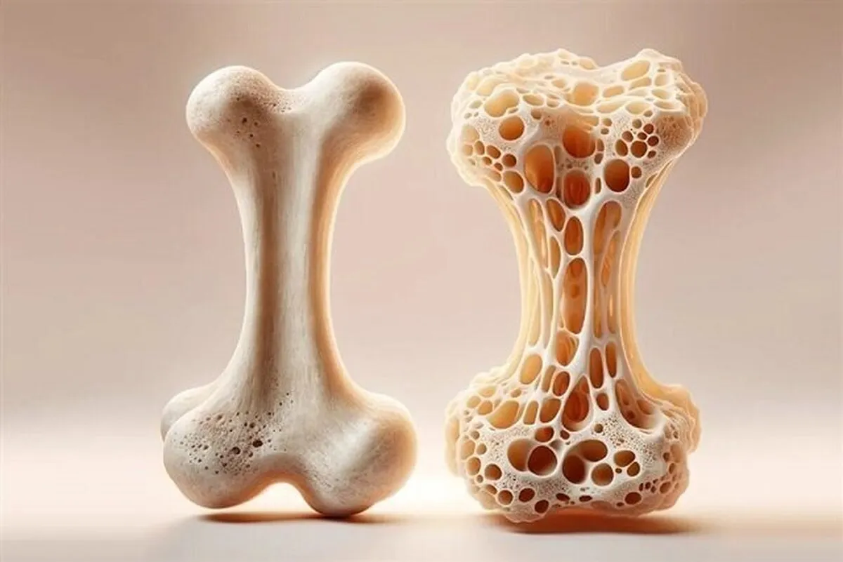 جلوگیری از پوکی استخوان با مصرف این ویتامین‌ها