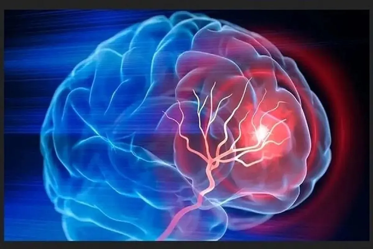 نقش فیزیوتراپی در درمان سکته مغزی